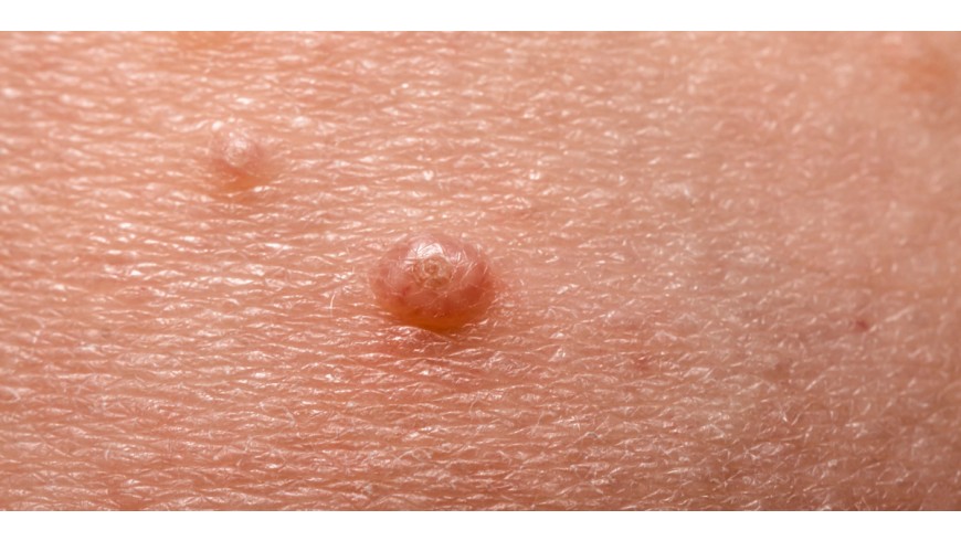 Nuestro hijo tiene Molluscum Contagiosum. ¿Qué son y como prevenirlos?