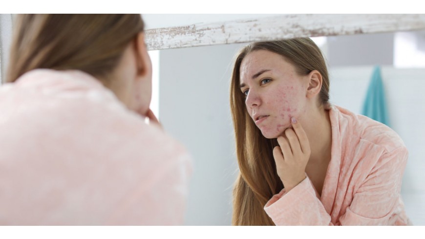 Acne, acne...propi de l'edat?