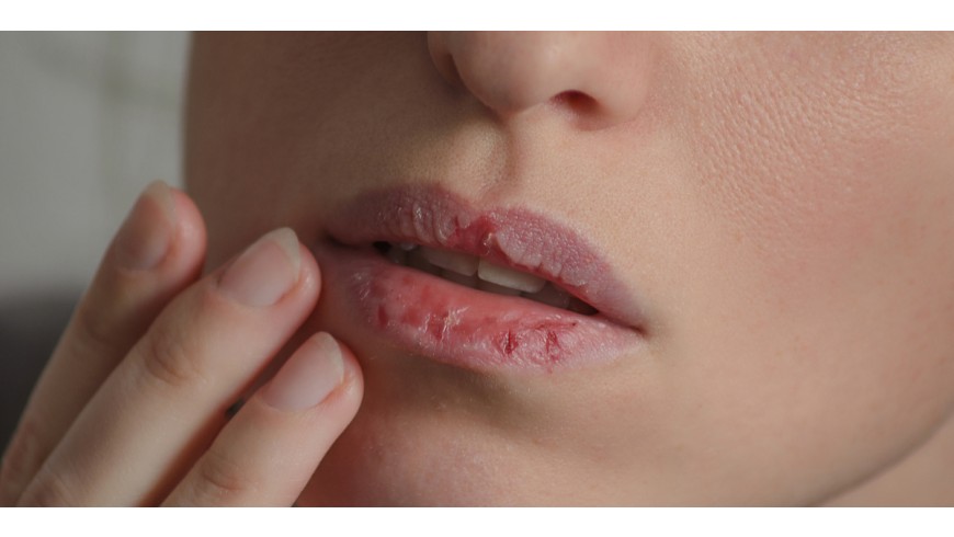 Alteracions labials