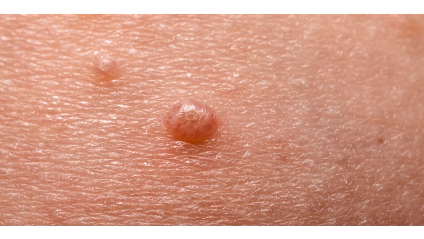 El nostre fill té Molluscum Contagiosum. Què són i com podem tractar-los?