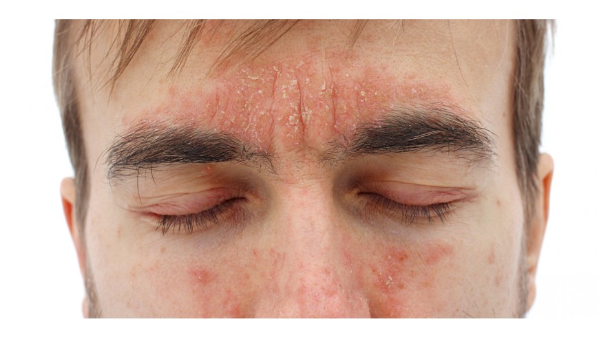 Parlem de la Dermatitis Seborreica