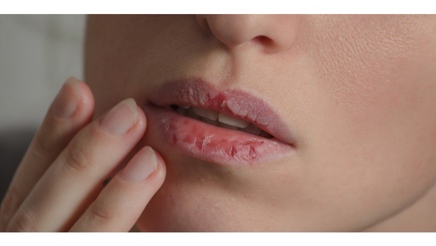 Alteraciones labiales